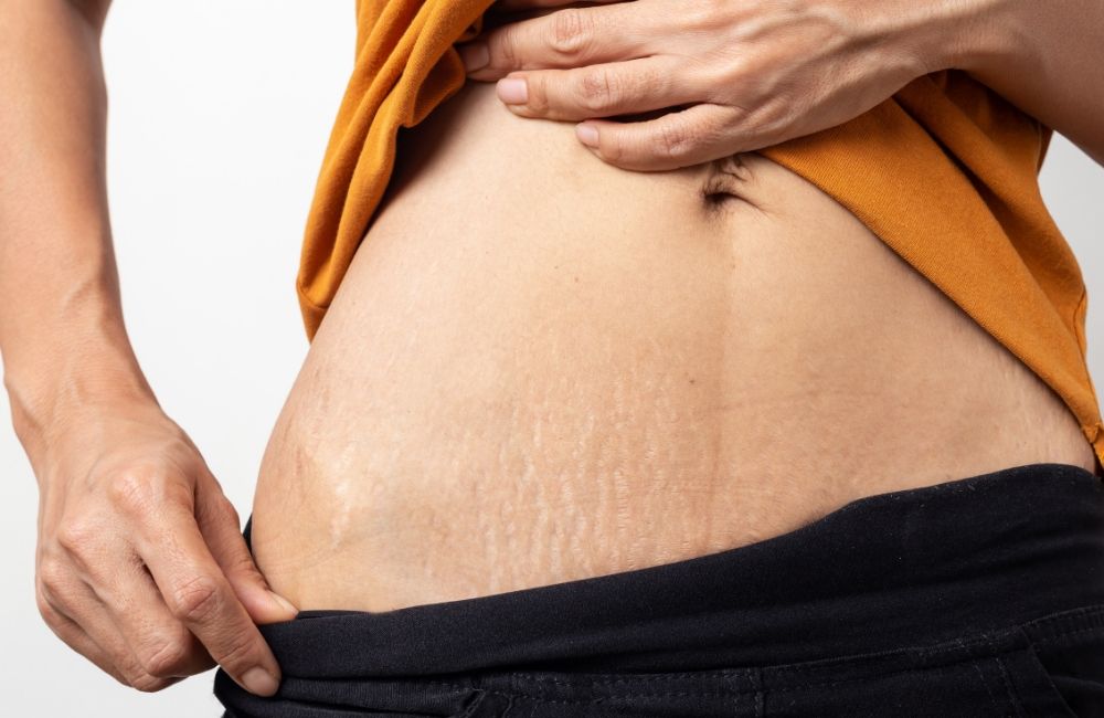 Come prevenire le smagliature?