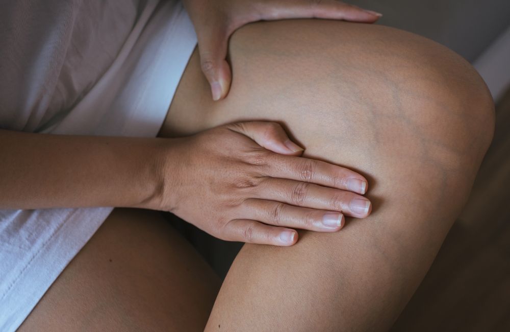 Differenza tra cellulite e ritenzione idrica