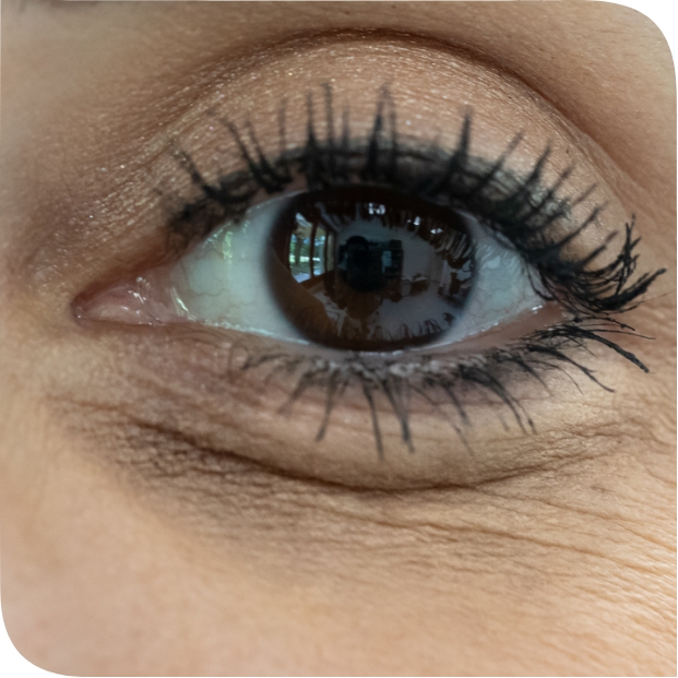 Borse sotto agli occhi