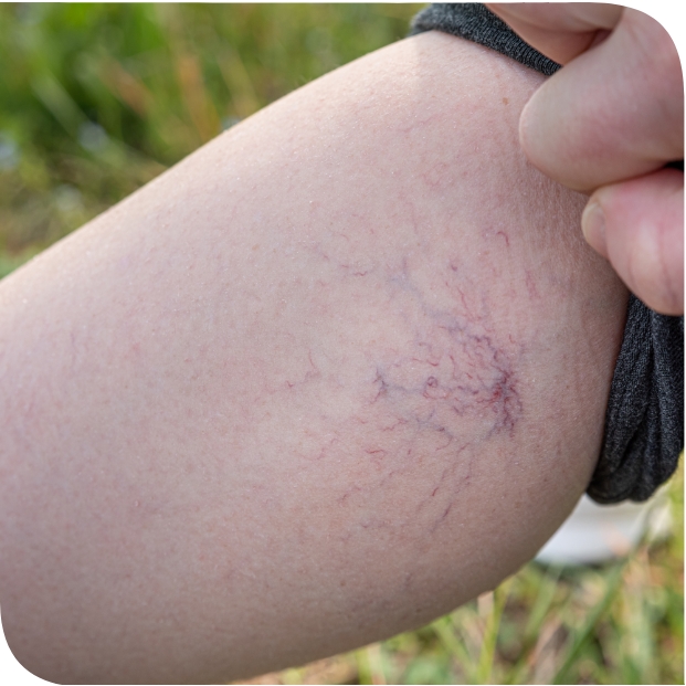 Fragilità Capillare