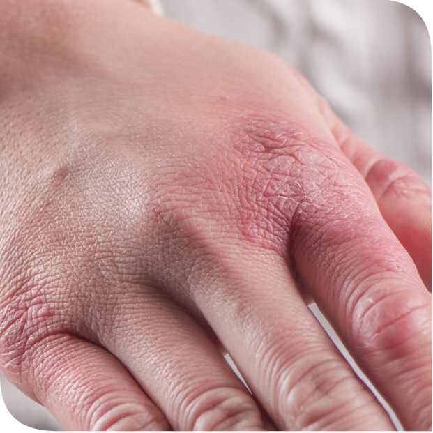 Geloni a Mani e Piedi