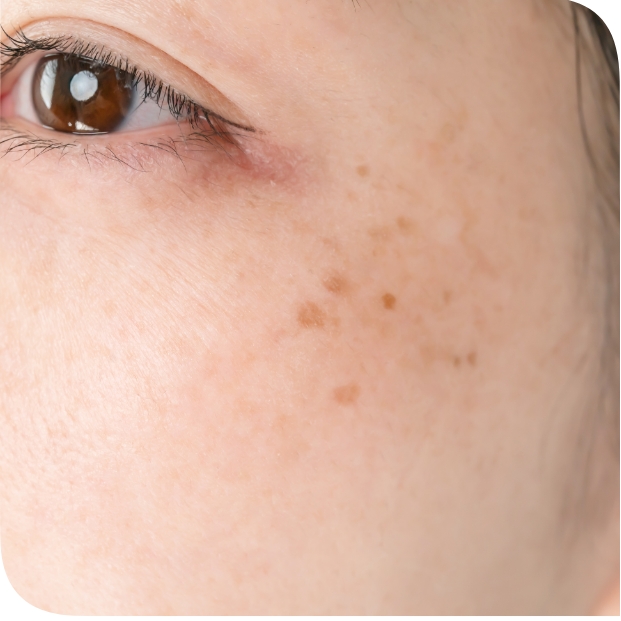 Iperpigmentazione Cutanea