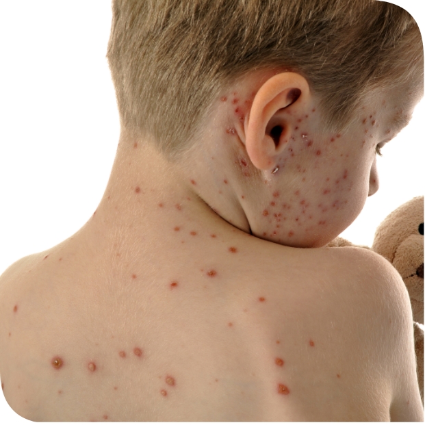 Varicella